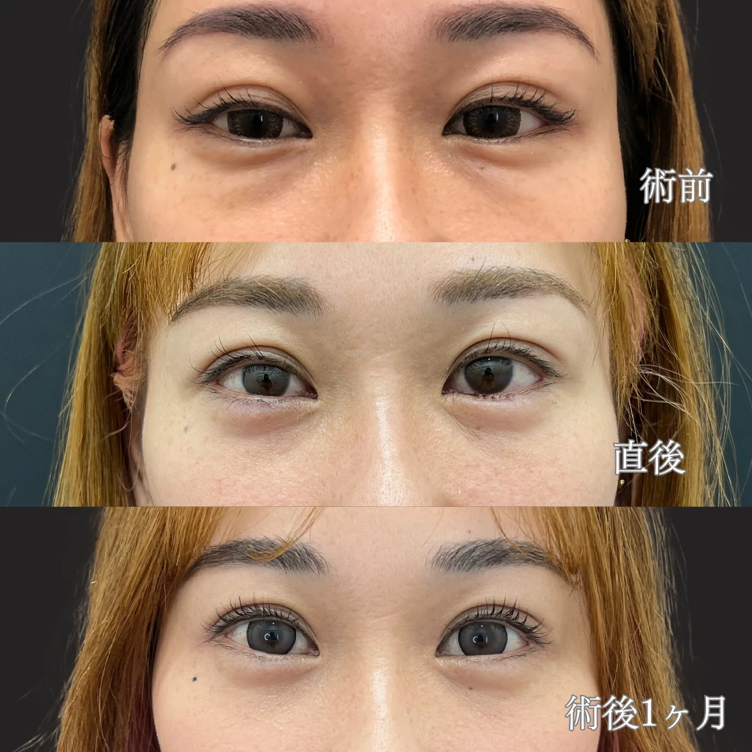 30代前半女性｜経結膜脱脂で自然な涙袋を形成