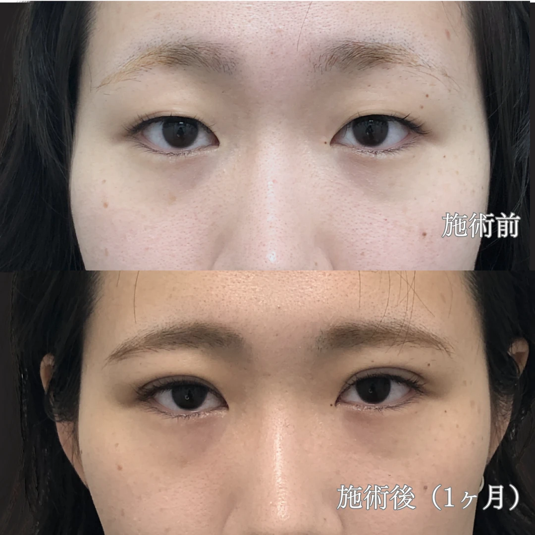 24歳女性｜自然癒着法ダブルモアで平行二重を実現